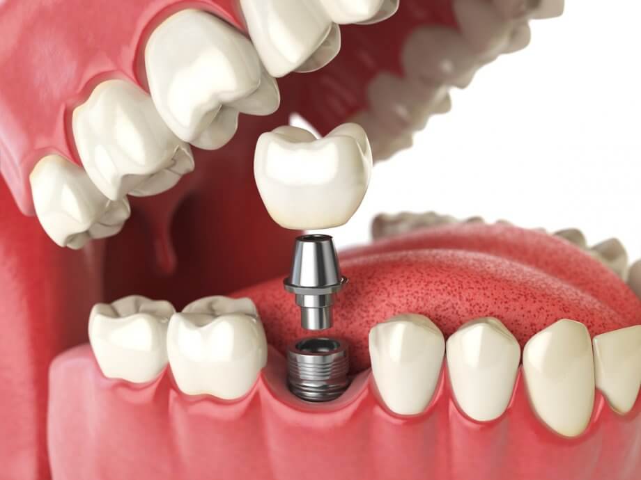 3D Illustration of Dental Implant