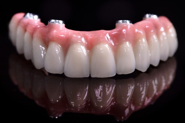Essential Things To Know About All On   Dental Implants