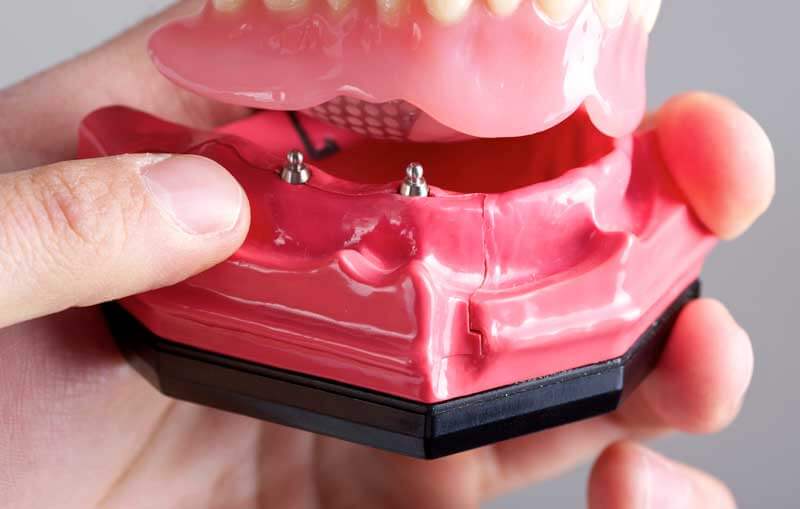Mini Dental Implants in North Attleborough
